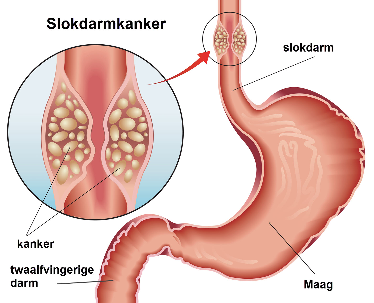 Slokdarmkanker Slingeland Ziekenhuis Slokdarmkanker Slingeland Ziekenhuis