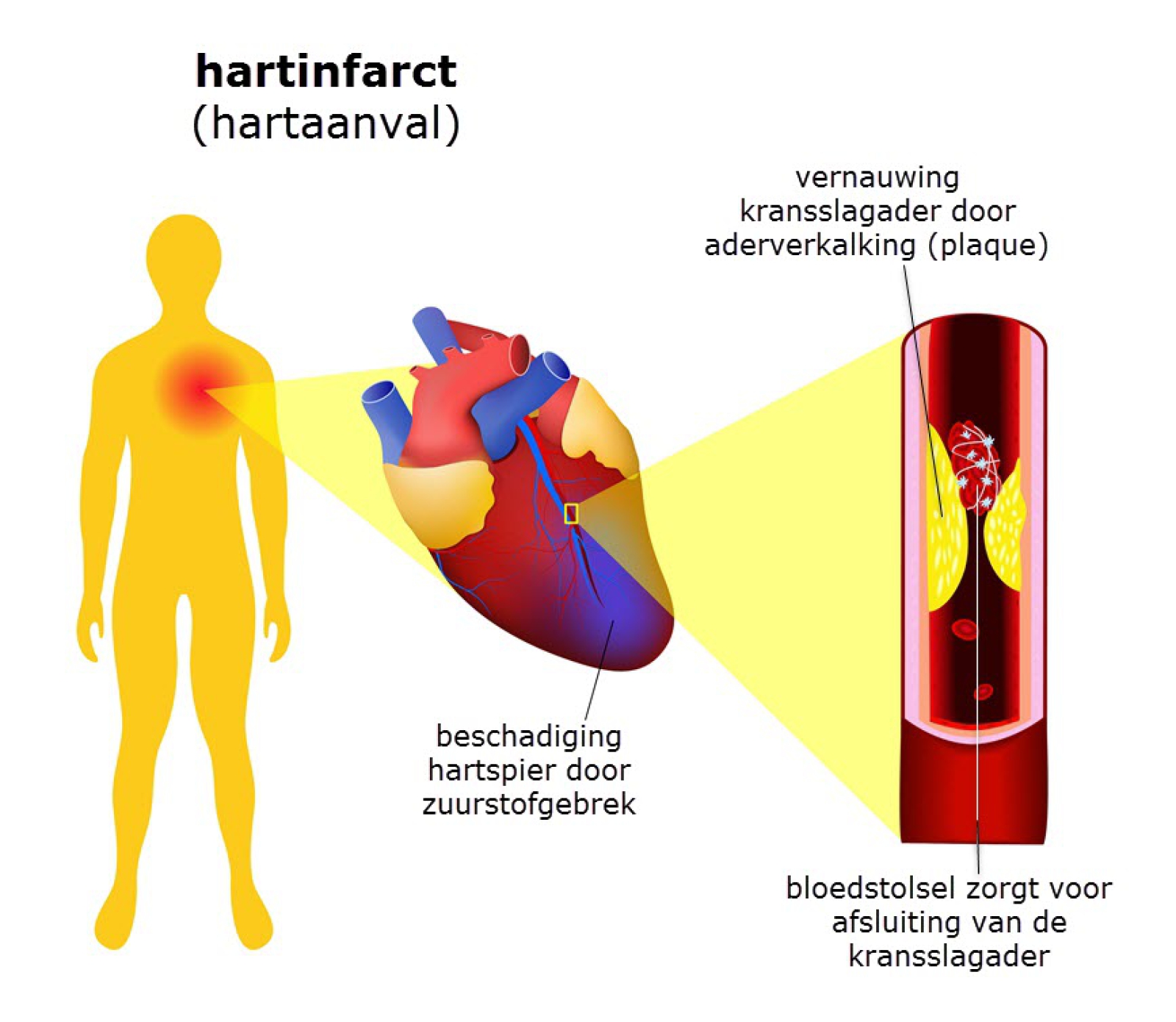 kristal enthousiasme steek Hartinfarct (hartaanval) - Slingeland Ziekenhuis