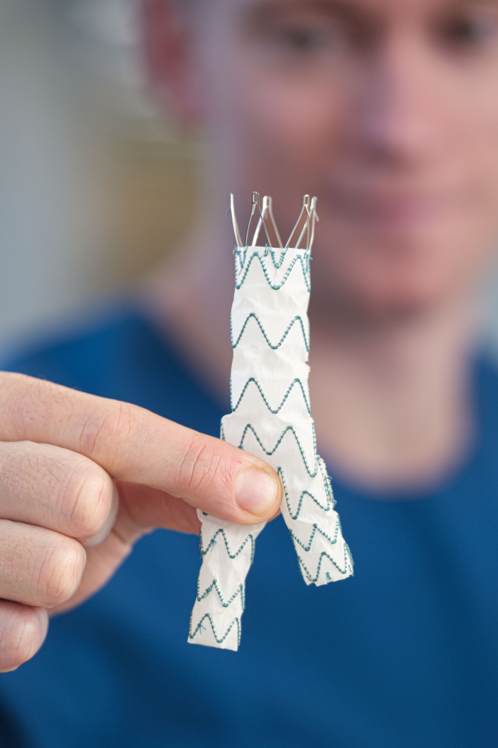 De vaatchirurg toont een stent, met twee ‘broekspijpjes’ voor de beenslagaders. Het plaatsen van de stent in een verwijde aorta is een belangrijke behandeling bij patiënten met een buikaneurysma boven de vijf centimeter. 