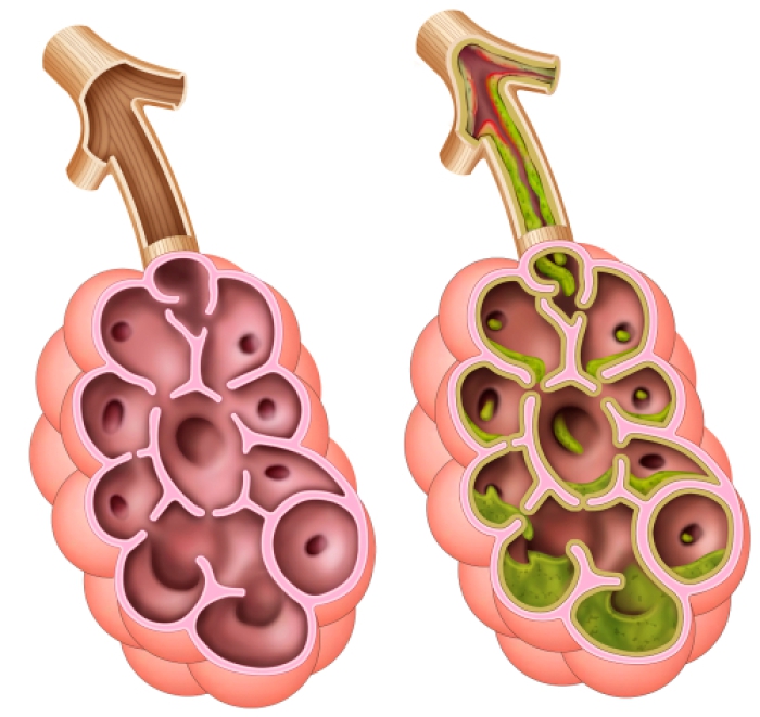 Grafische weergave van gezonde longblaasjes en de slijmlaag in de longblaasjes die zijn aangetast door cystic fibrosis