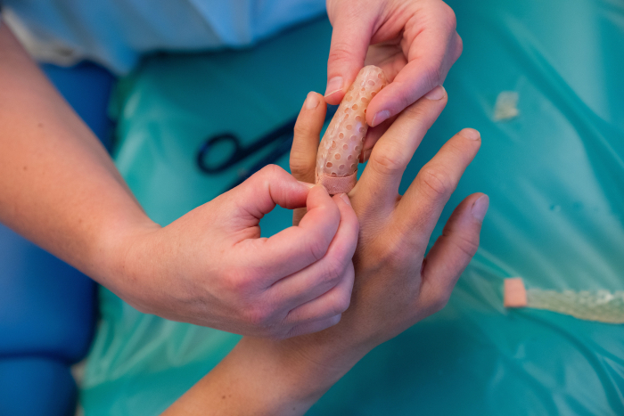 Het maken van een vingerspalk met thermoplast