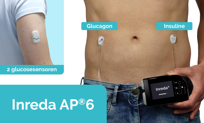 Prototype Inreda AP6. De kunstalvleesklier zit met twee slangetjes verbonden aan de buik van de patiënt. ©Inreda Diabetic