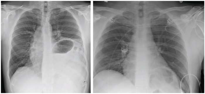 röntgenbeeld voor en na de operatie