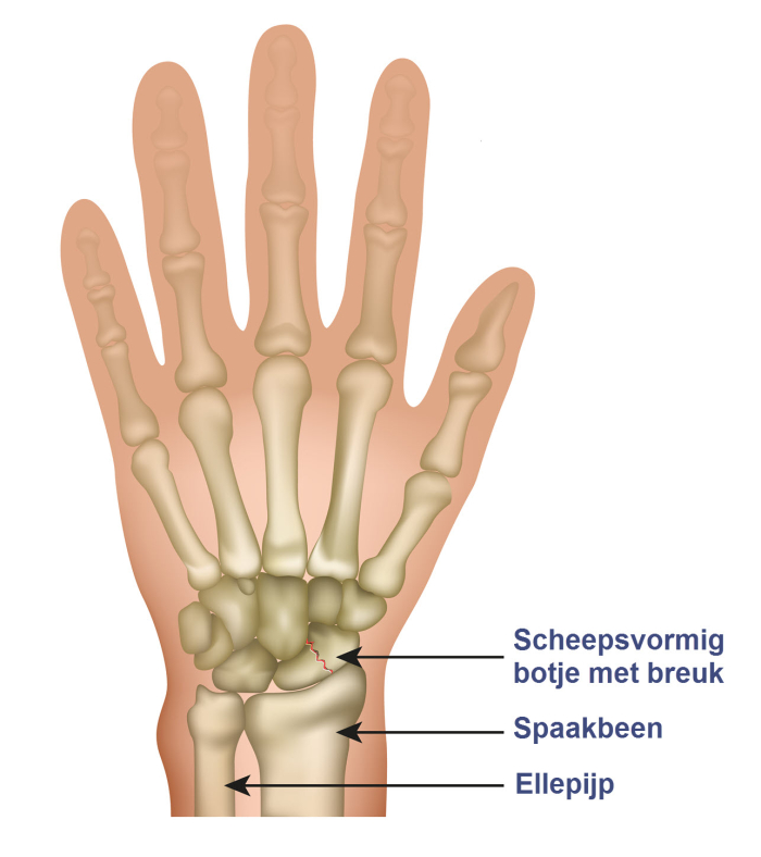 Illustratieve afbeelding van botjes in de hand met het scheepsbotje boven het spaakbeen in de basis van de hand.