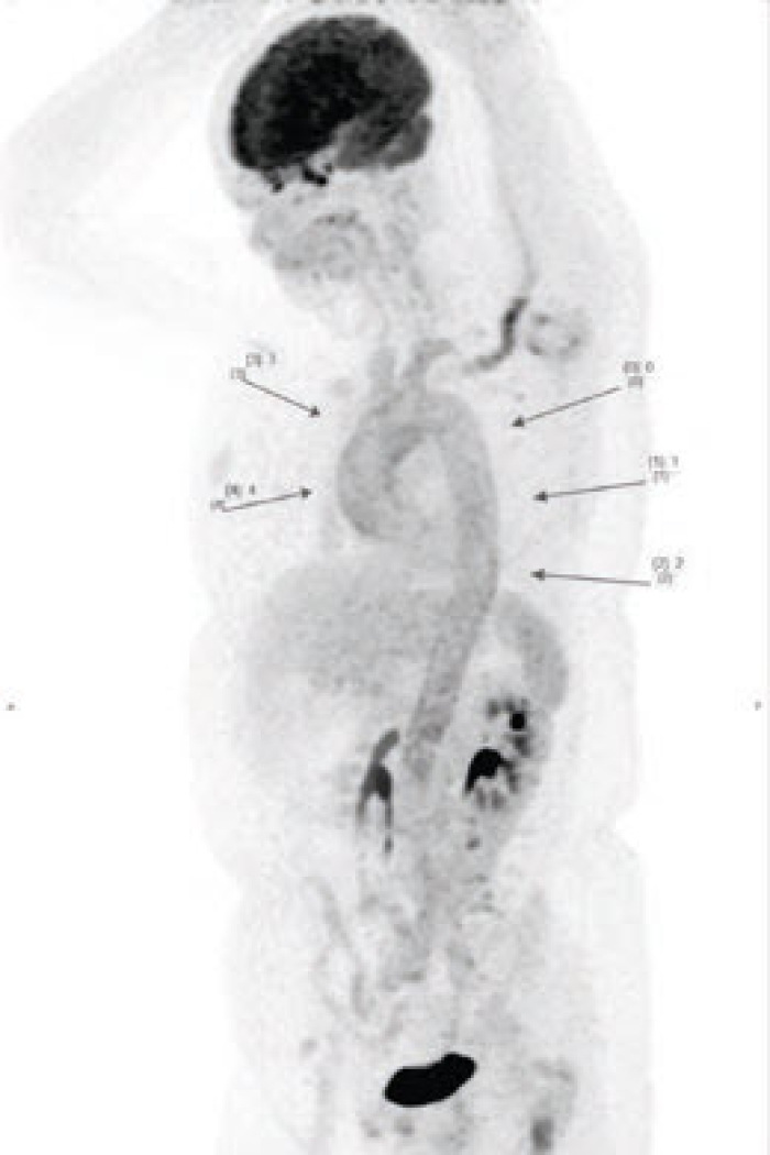 Beeld van vasculitis van PET-scan.