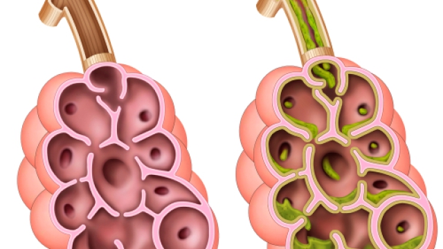 Grafische weergave van gezonde longblaasjes en de slijmlaag in de longblaasjes die zijn aangetast door cystic fibrosis