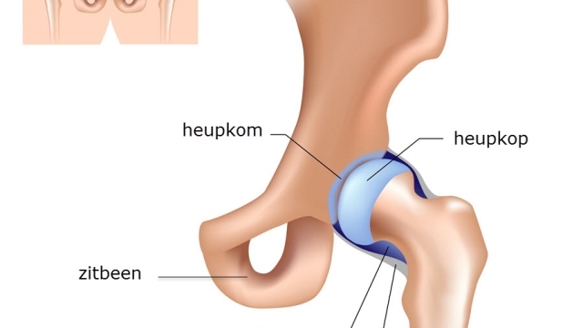 Grafische weergave van het heupgewricht