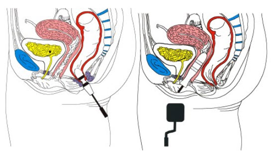 Probe ingebracht via de anus (links) en vagina (rechts)